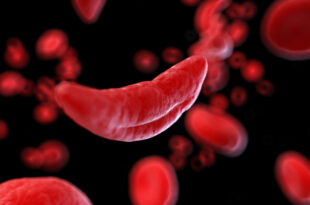 anemia cellula sangue