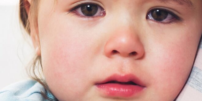 Dermatite nei bambini e vitamina D
