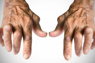 artrite reumatoide infliximab
