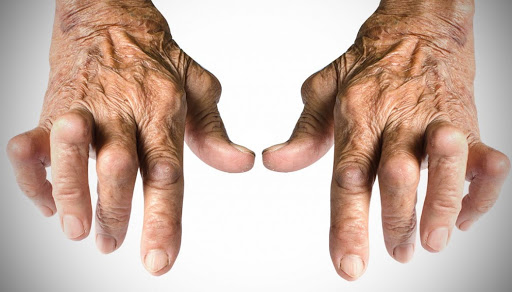 artrite reumatoide infliximab