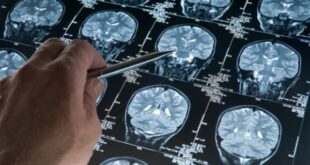 ricerca malattia salute, mente Alzheimer